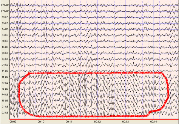 Alpha Brainwave Activity In Raw Eeg Scottsdale Neurofeedback