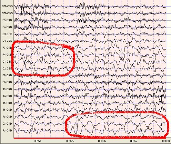 Delta Waves Scottsdale Neurofeedback Institute Az